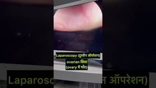 Ovary cyst laparoscopy operation how obstetrician trending cutebaby obstetrics neet neet2024 [upl. by Ahseniuq]