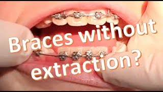 Nonextraction Orthodontics 2x4 Dgainer Mechanics [upl. by Yleve]