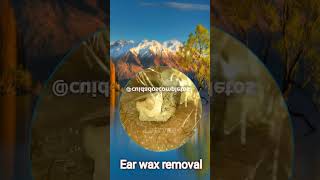 Removal of a strong large ear wax [upl. by Marys]