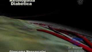 Glaucoma Neovascular en diabetes [upl. by Anibas]