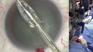 ZEPTO® Precision Cataract Surgery Technology Safety Performance [upl. by Riba]