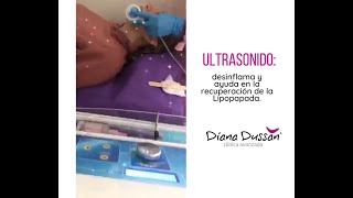 ☝️🥰 Ultrasonido desinflama y ayuda en la recuperación de la Lipopapada [upl. by Guenna308]