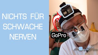 Zahnarzt filmt Weisheitszahn OP mit GoPro Vollnarkose [upl. by Bremen]