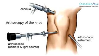 How long does it take to recover from Arthroscopic Knee Surgery [upl. by Yeroc]