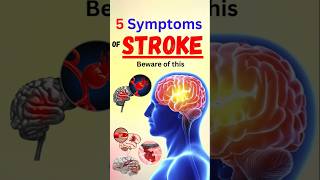 5 Symptoms of Stroke Beware of this [upl. by Eeramit800]