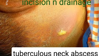 tuberculous neck abscess  incision n drainage  dr youtube doctor [upl. by Peck]