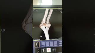 Ct scan 3D Elbow dislocation ctscan radiology viralvideo [upl. by Karia]