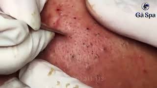 Blackheads 7750 [upl. by Suivatnod]