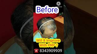 PRP HAIR LOSS TREATMENT BEFORE AND AFETR  YTSHORTS SHORTS [upl. by Burkhard223]