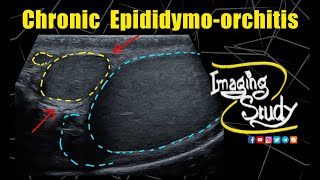 Chronic Epididymoorchitis  Ultrasound  Case 328 [upl. by Flosser89]