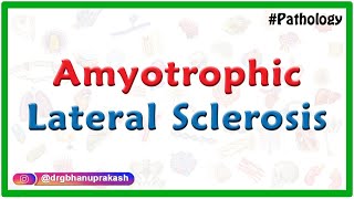 Amyotrophic Lateral Sclerosis Etiology Pathology Clinical maifestations Diagnosis and Treatment [upl. by Ozne]