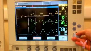 Maximum Inspiratory Pressure MIP or Negative Inspiratory Force NIF on Maquet Servoi [upl. by Ecital207]