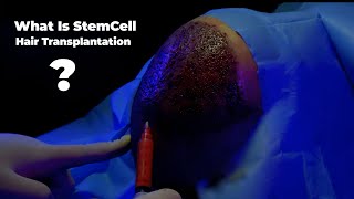 What is stem cell hair transplantation [upl. by Siusan]