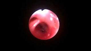 Veterinary Bronchoscopy413 Mild interstitial pneumonia MDachshund 13y F [upl. by Edlun168]