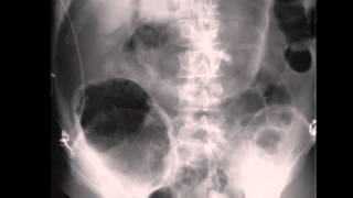 Large Pneumoperitoneum on Abdominal X ray [upl. by Acimat97]