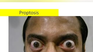 Proptosis  etiology type and work up protocol [upl. by Marilla54]