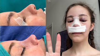 why my 2 nose jobs werent worth it part 1 MY EXPERIENCE PHOTOS VLOG [upl. by Eddy]