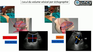 Evaluation du contenu vésical sous échographie [upl. by Willie]