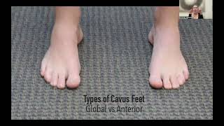 Meet the Cavus Foot  The Functional Impact of High Arches with Dr Emily [upl. by Nove]