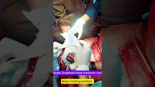 Pop cast for scaphoid bone fracture orthopedics shortvideo [upl. by Kelton13]