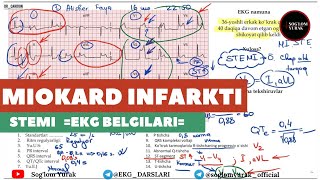 EKG Tahlili05  Miokard Infarkti  EKG Namunasi [upl. by Fitalludba]