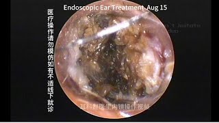 External auditory canal cholesteatoma misdiagnosed as cerumen embolism [upl. by Cyma]