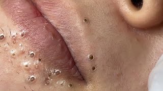 Big Cystic Acne Blackheads Extraction Blackheads amp Milia Whiteheads Removal Pimple Popping  9248 [upl. by Lavina]