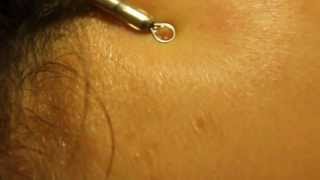 Blackhead extraction with Slow Motion HD  forehead zit [upl. by Tdnaltroc]