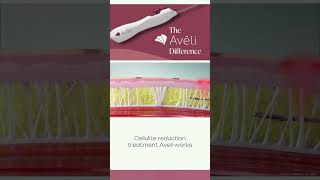 Curious about cellulite solutions Aveli got you 🌟 AveliTreatment CelluliteSolutions [upl. by Eng121]