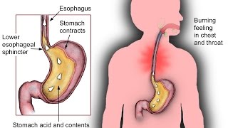 How to Stop Belching and bloating Using Different home Strategies no more acid reflux belching [upl. by Ttcos]