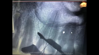 Endodoncia en vivo [upl. by Ajat]