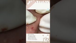 Big Cystic Acne Blackheads Extraction Blackheads amp Milia Whiteheads Removal Pimple Popping shorts [upl. by Janith308]