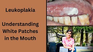 Leukoplakia Understanding White Patches in the Mouth [upl. by Quar]