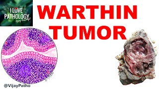 WARTHIN TUMOR  Etiopathogenesis Clinical features Gross and Microscopic features [upl. by Clayton]