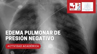 Edema pulmonar de presión negativo [upl. by Ahsat]