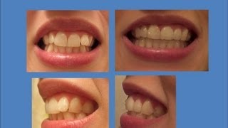 INVISALIGN Update Tray 21 last tray amp Refinements [upl. by Colston]