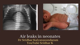 Air leaks in neonatesa quick review of the types of air leaks Dr Sridhar Kalyanasundaram [upl. by Aneleh94]