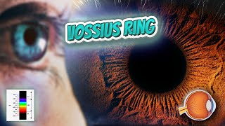 Vossius ring Your EYEBALLS 👁️👁️💉😳💊🔊💯✅ [upl. by Anima770]