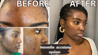 GETTING RID OF ACNE amp HYPERPIGMENTATION  6 MONTHS ACCUTANE UPDATE  ACCUTANE JOURNEY [upl. by Ynohtna15]