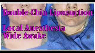 Double Chin Liposuction Quick Procedure VideoLocal Anesthesia Wide Awake [upl. by Adnohsal]