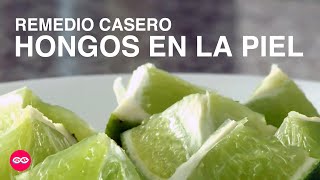 ¿Cómo quitar Hongos en la Piel con Remedios Caseros remedioscaseros  Sin Récipe [upl. by Kohsa40]