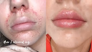 HOW I CLEARED MY PERIORAL DERMATITIS [upl. by Truk]