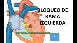 BLOQUEO RAMA IZQUIERDA ECG EDWARCOOL [upl. by Leoj]