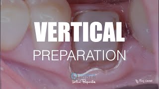 TT Vertical Preparation Full Protocol [upl. by Eirelav955]