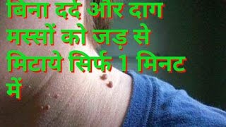 बिना दाग मस्से हटाए सिर्फ एक मिनट मे मस्से का आयुर्वेदिक उपचार Remove warts in 1 minute [upl. by Ennyl611]