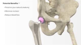 Direct Anterior Approach Hip Replacement [upl. by Haraj]