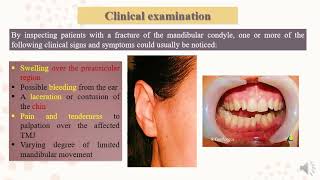 Condylar Fractures [upl. by Fenwick986]