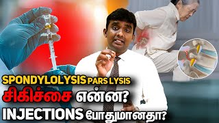 L45 L5S1 Spondylolisthesis Part 8 சிறு வயதில் பாதிப்பு ஏற்படுமா [upl. by Robins]