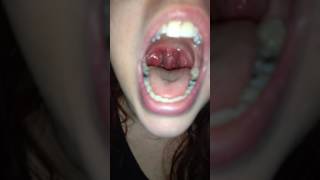 Girlfriends strep throat [upl. by Fonville]