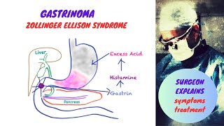 Gastrinoma  Zollinger Ellison Syndrome [upl. by Fabron879]